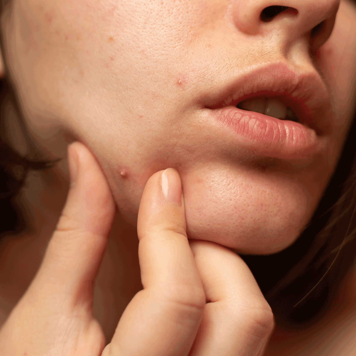 Acne-Skincare-1